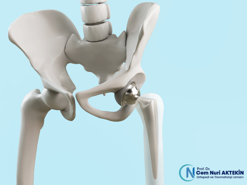 kalca-protezi-ameliyati-ne-kadar-surer